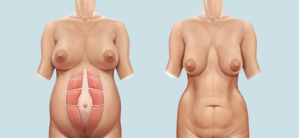 Diástasis abdominal postparto
